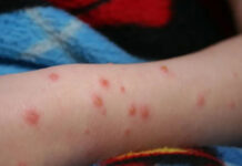 Rujeola, o boală fatală pentru 1/1000 de români