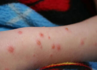Rujeola, o boală fatală pentru 1/1000 de români